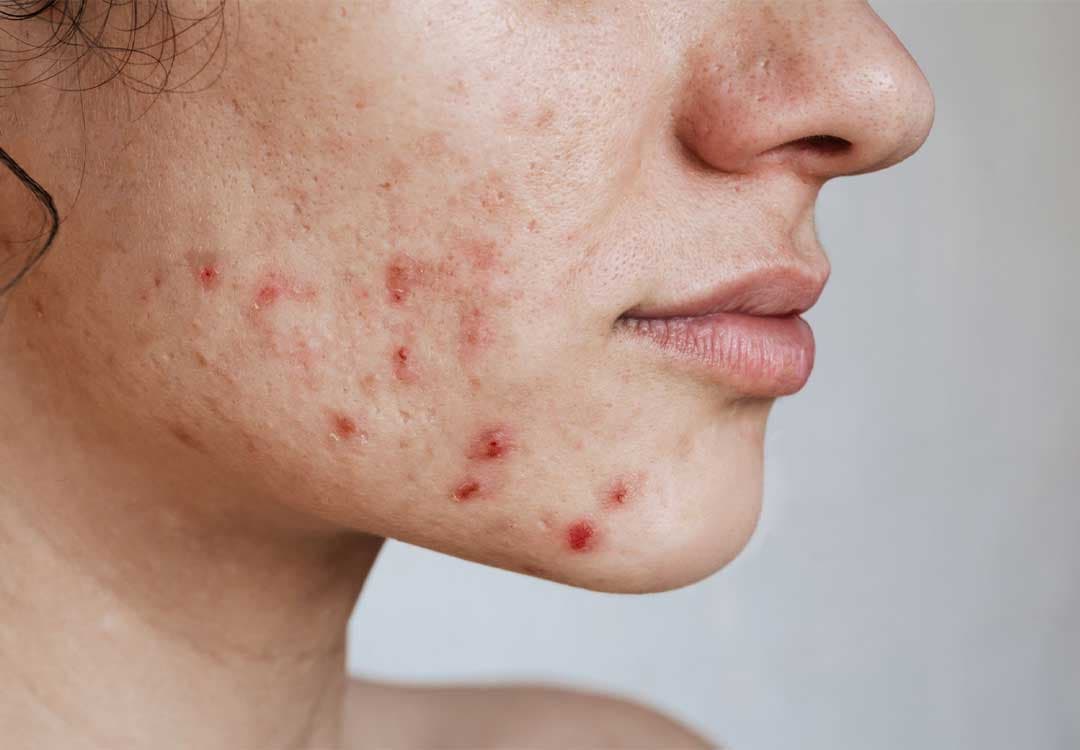 black heads