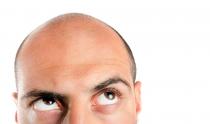 Men Hair Loss