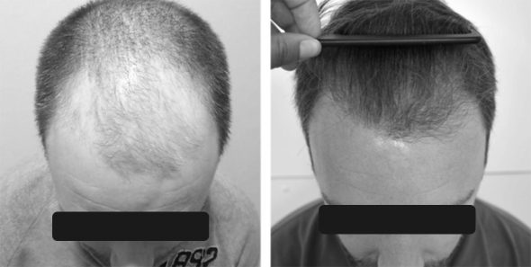 Hair Transplant—Common Questions Answered | Clinic Dermatech