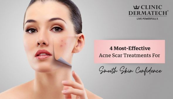 4 Most-Effective Acne Scar Treatments For Smooth Skin Confidence