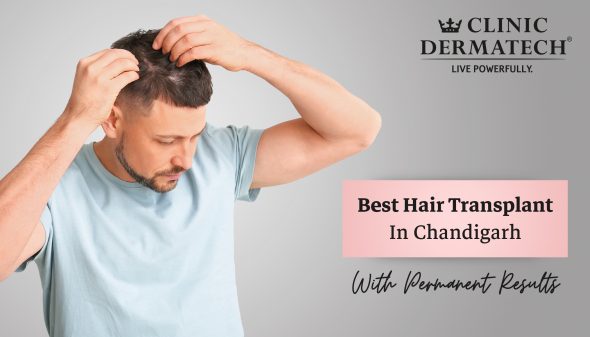 hair transplant cost in Chandigarh Archives - Skin & hair care Tips -  Clinic Dermatech