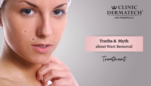 Truths And Myth About Wart Removal Treatment Clinic Dermatech