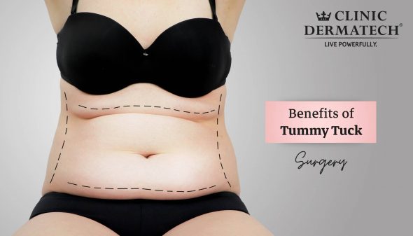 Benefits of Tummy Tuck Surgery