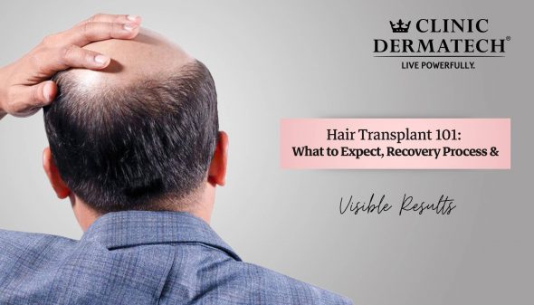 Hair Transplant 101: What to Expect, Recovery Process & Visible Results