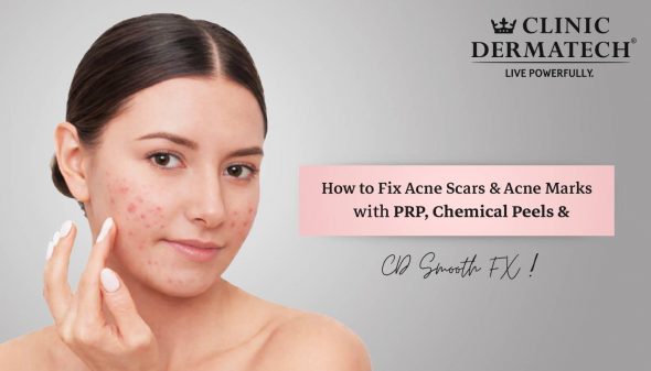 How to Fix Acne Scars & Acne Marks with PRP, Chemical Peels & CD Smooth FX