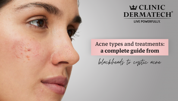 Acne Types And Treatments: A Complete Guide From Blackheads To Cystic Acne